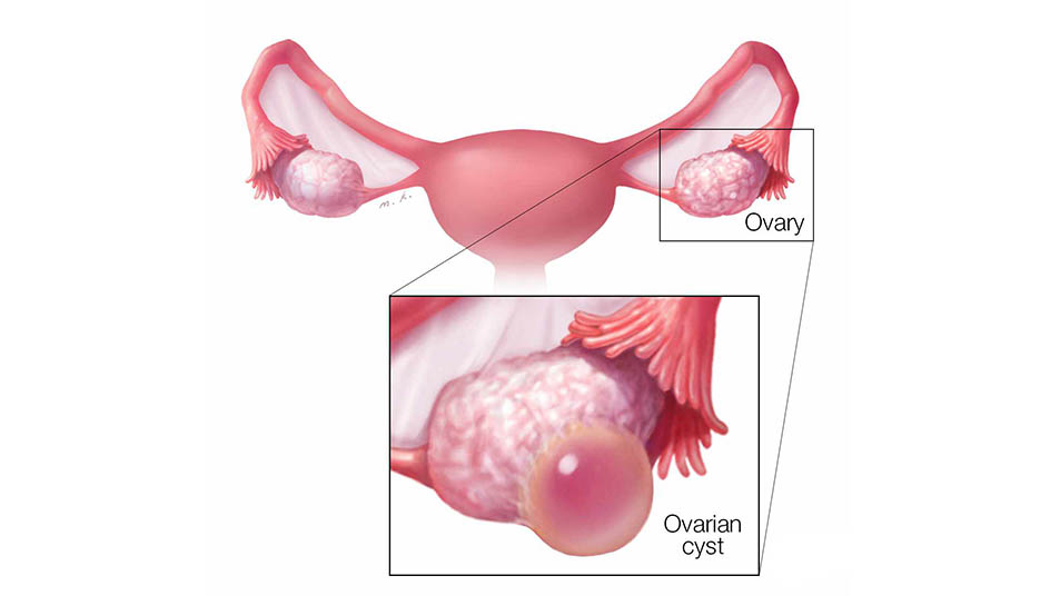Ovarian Removal Surgery